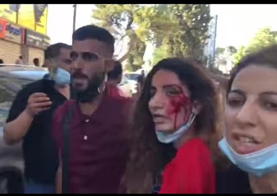 injured palestinian woman